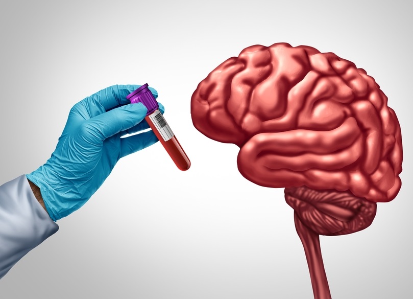 Imagen: El nuevo análisis de sangre para el Alzheimer podría cambiar la forma en que se detecta y diagnostica la enfermedad (foto cortesía de Shutterstock)